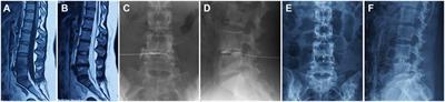 Oblique lateral interbody fusion stand-alone vs. combined with percutaneous pedicle screw fixation in the treatment of discogenic low back pain